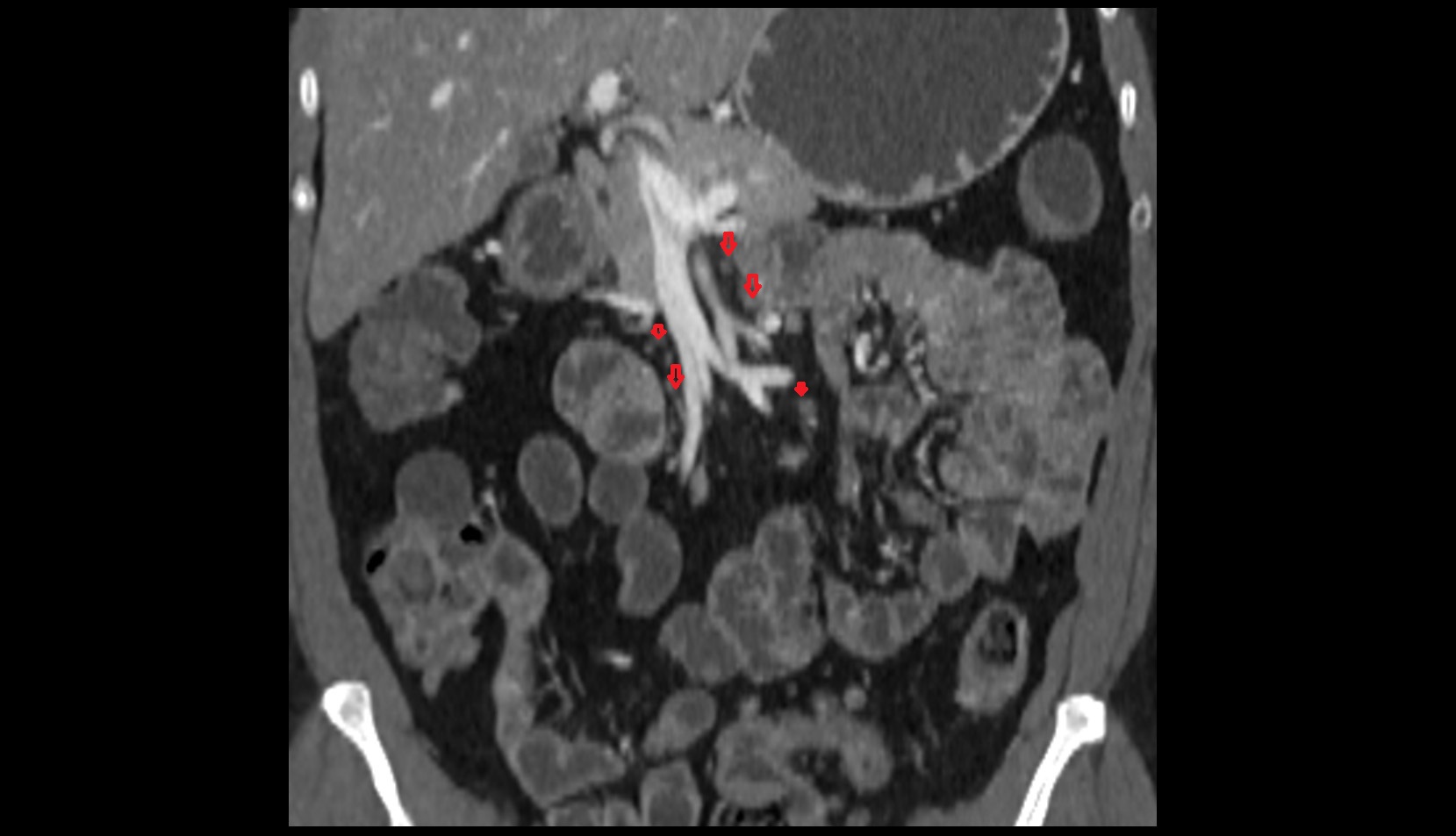 Superior mesenteric lymph nodes CT coronal imag 1