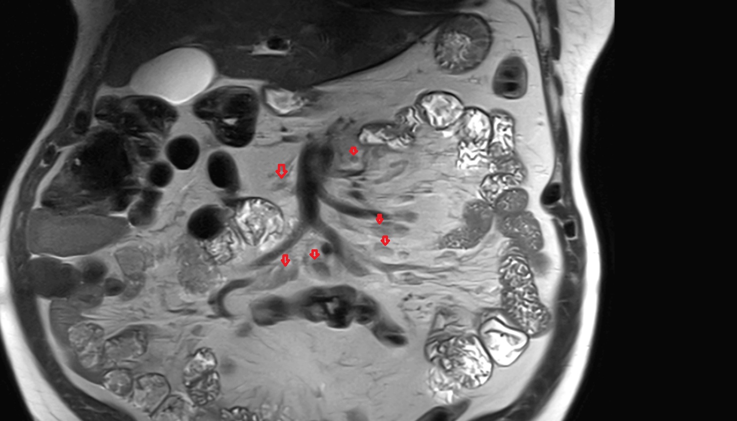 Superior mesenteric lymph nodes    MRI coronal  image anatomy  image -img-00000-00000