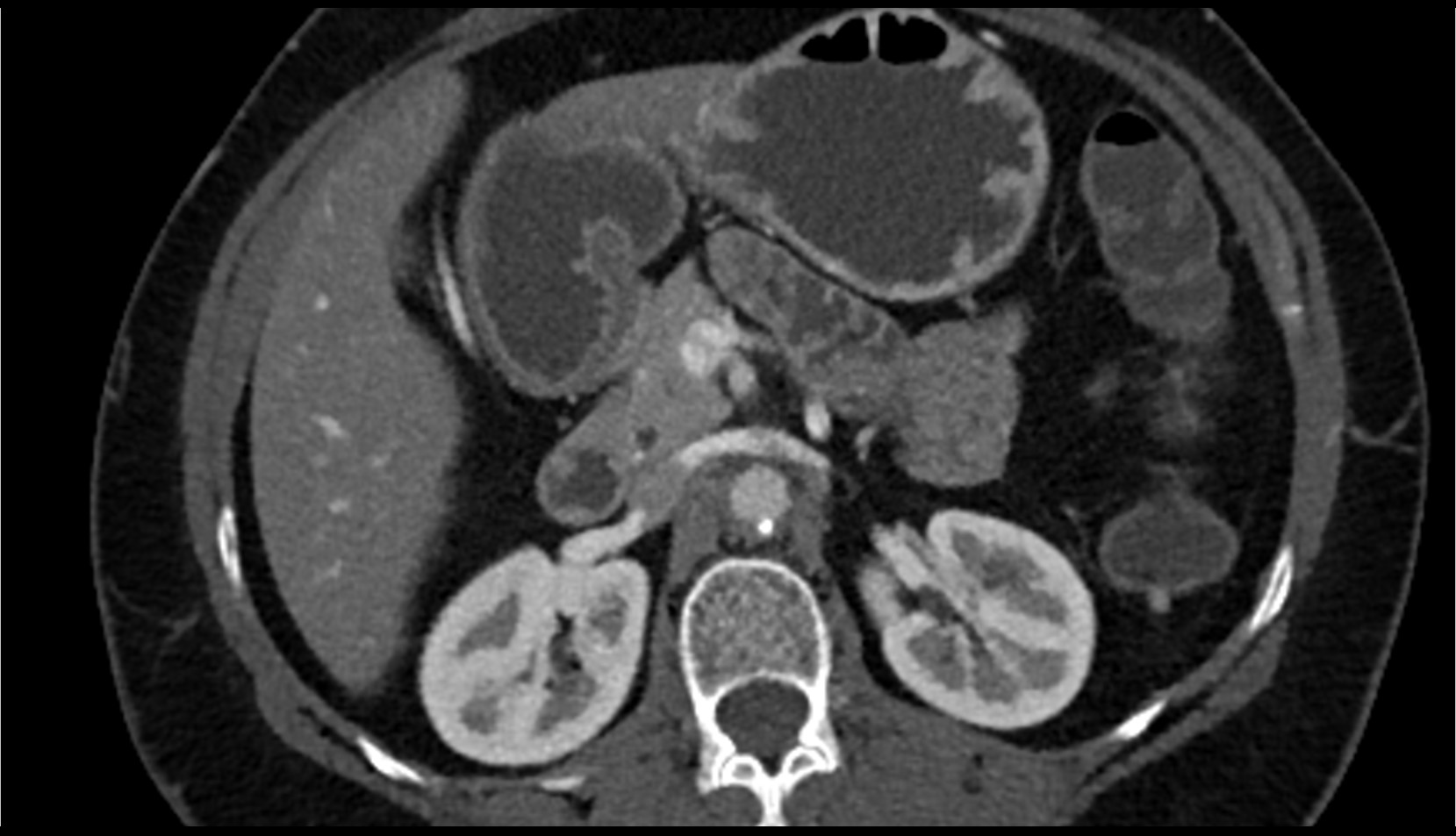 Superior mesenteric vein (SMV) CT axial image