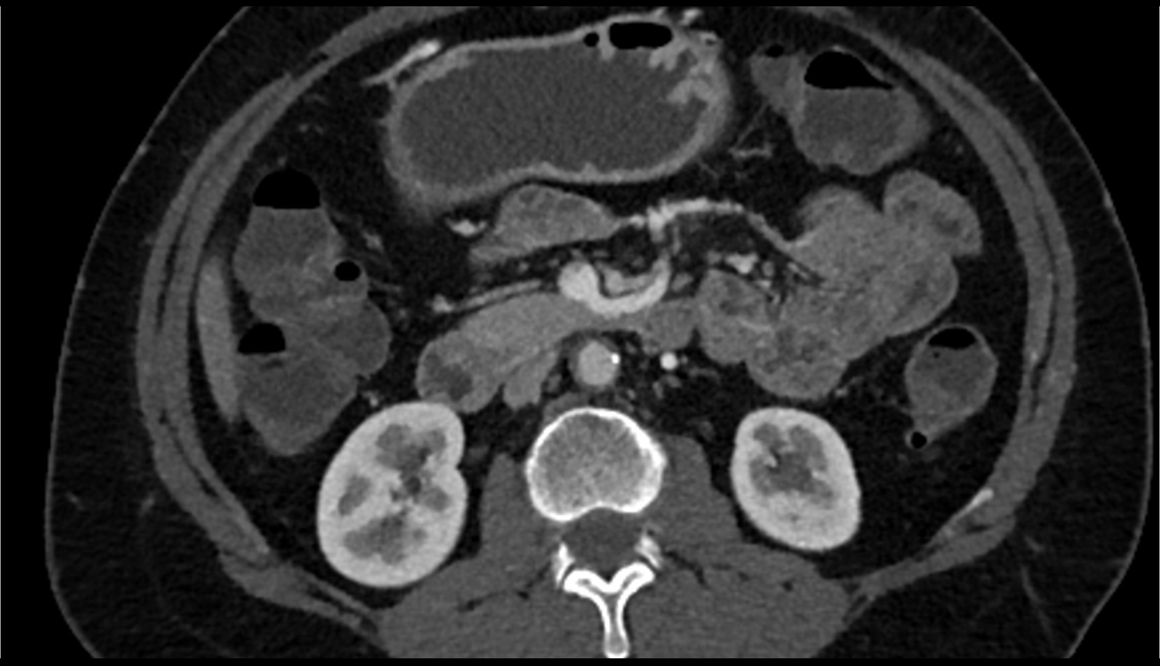 Superior mesenteric vein (SMV) CT axial image 1