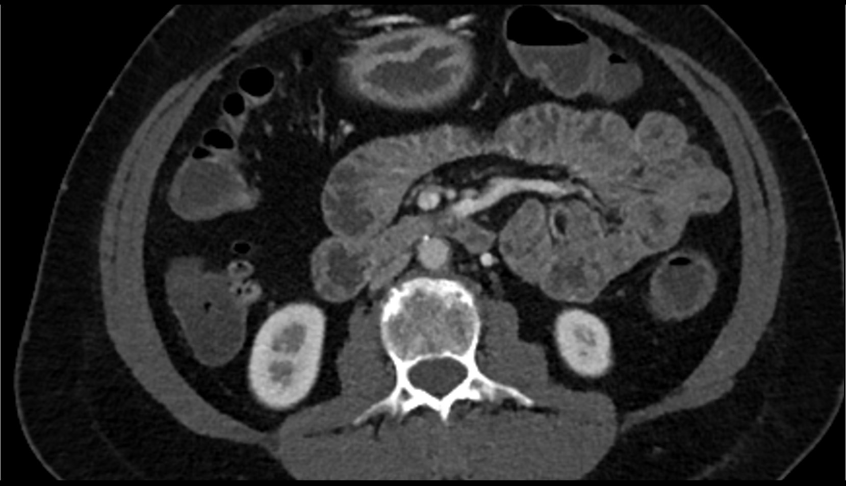 Superior mesenteric vein (SMV) CT axial image 2