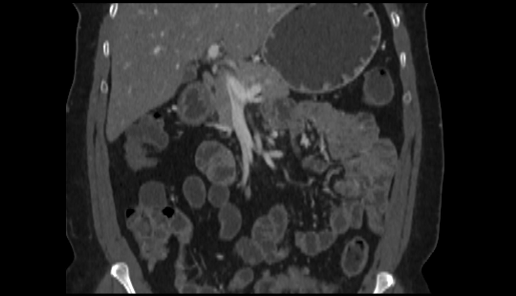 Superior mesenteric vein (SMV) CT coronal image