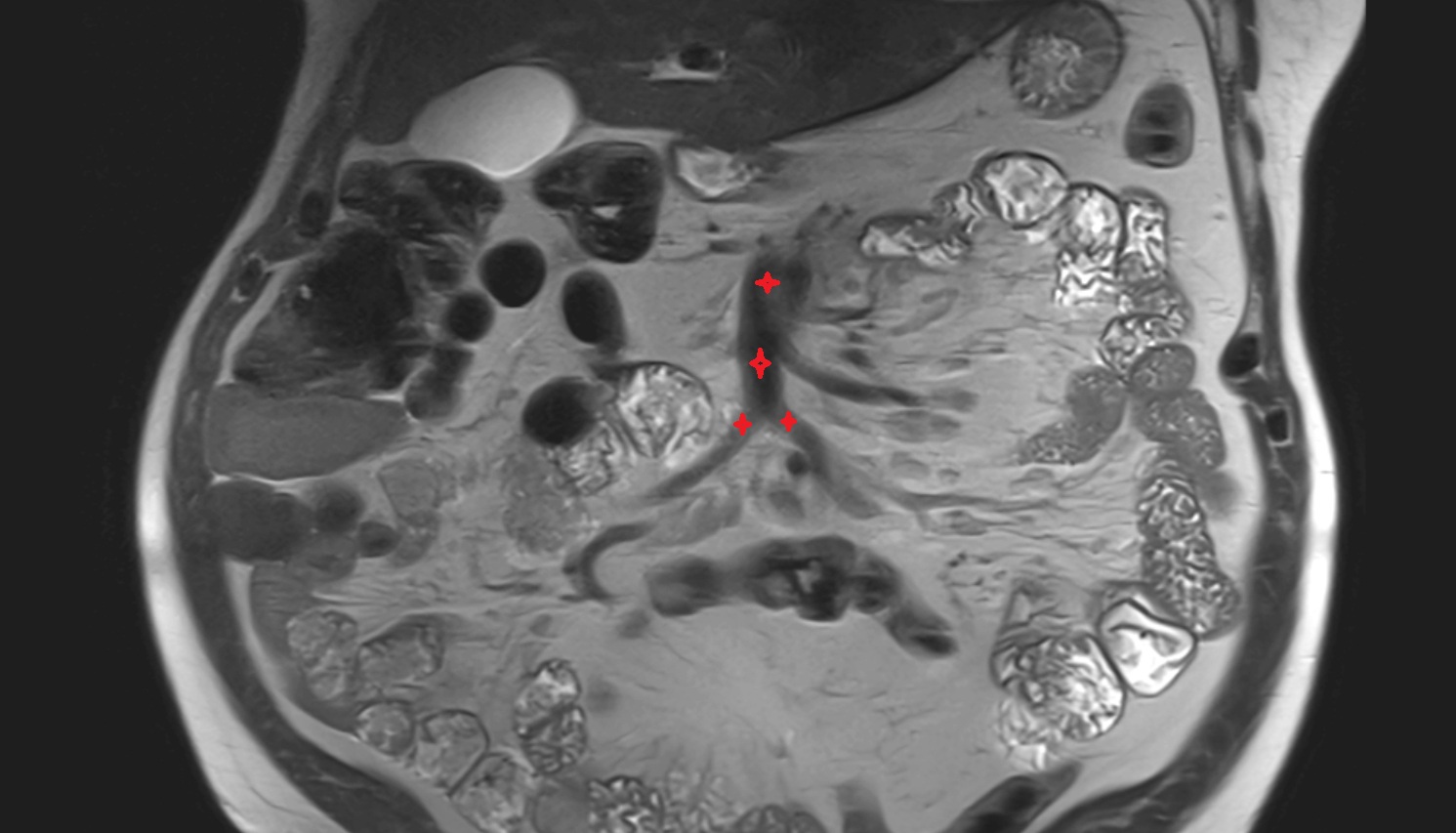 Superior mesenteric vein (SMV)  MRI coronal  anatomy  image -img-00000-00000