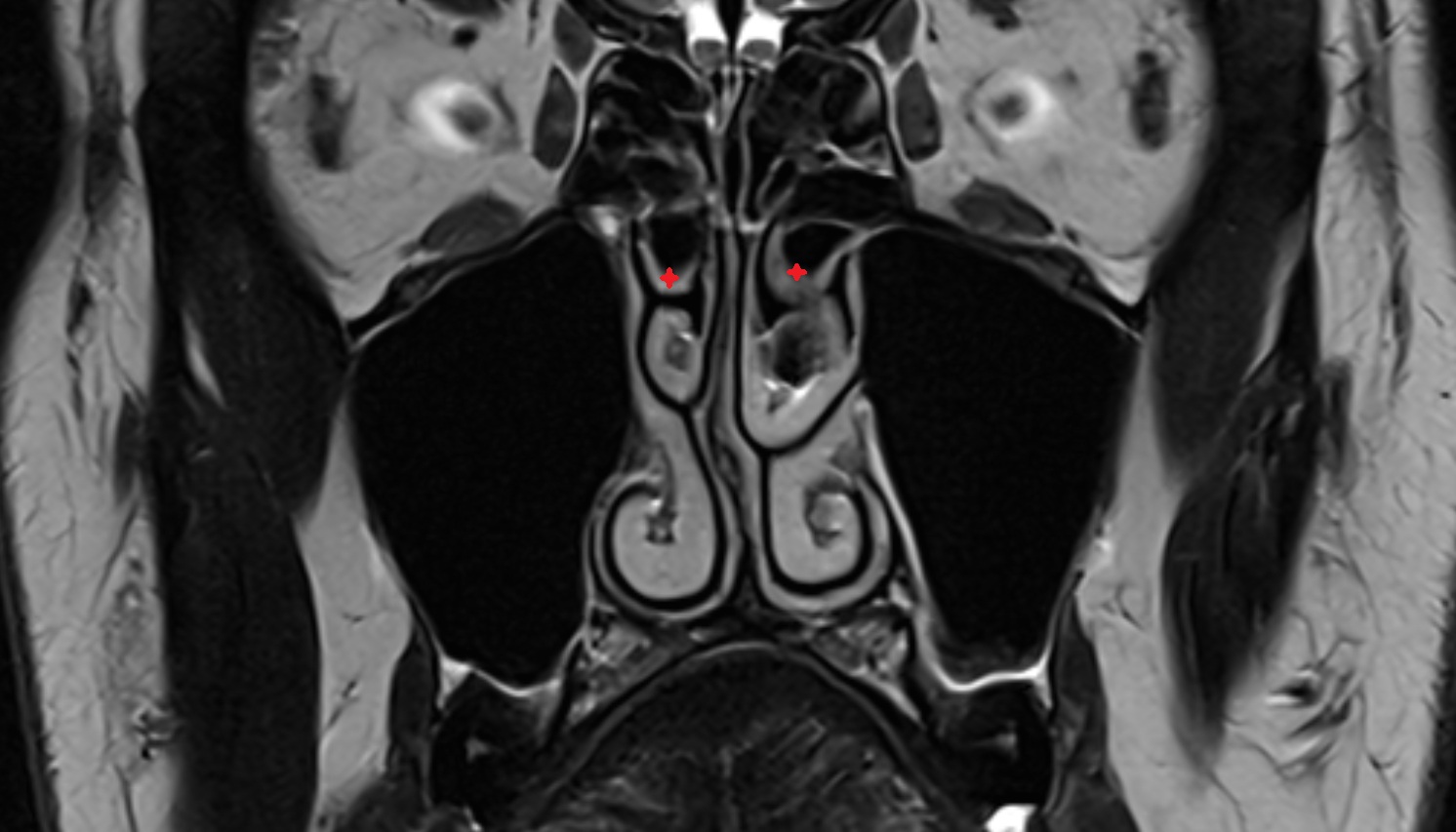 Superior nasal concha  mri coronal image -img-00000-00000