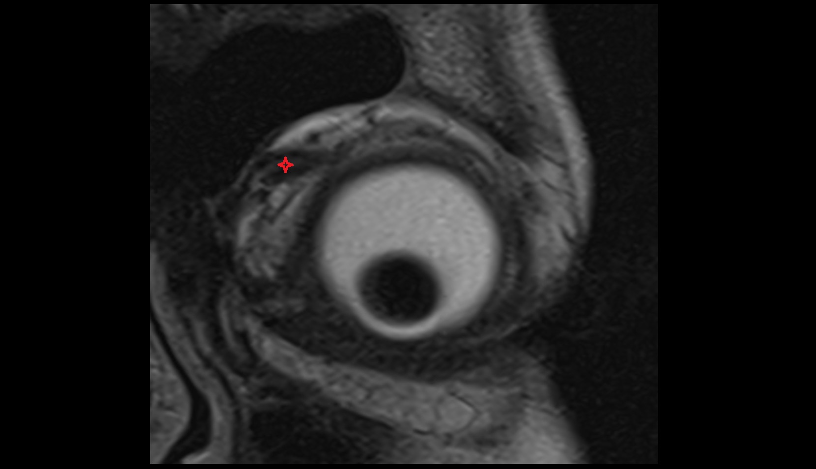 Superior oblique muscle mri image