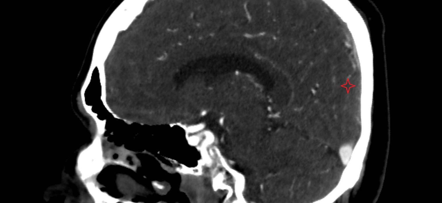 Superior occipital gyrus  CT sagittal  cross sectional anatomy radiology image -img-00001-00001