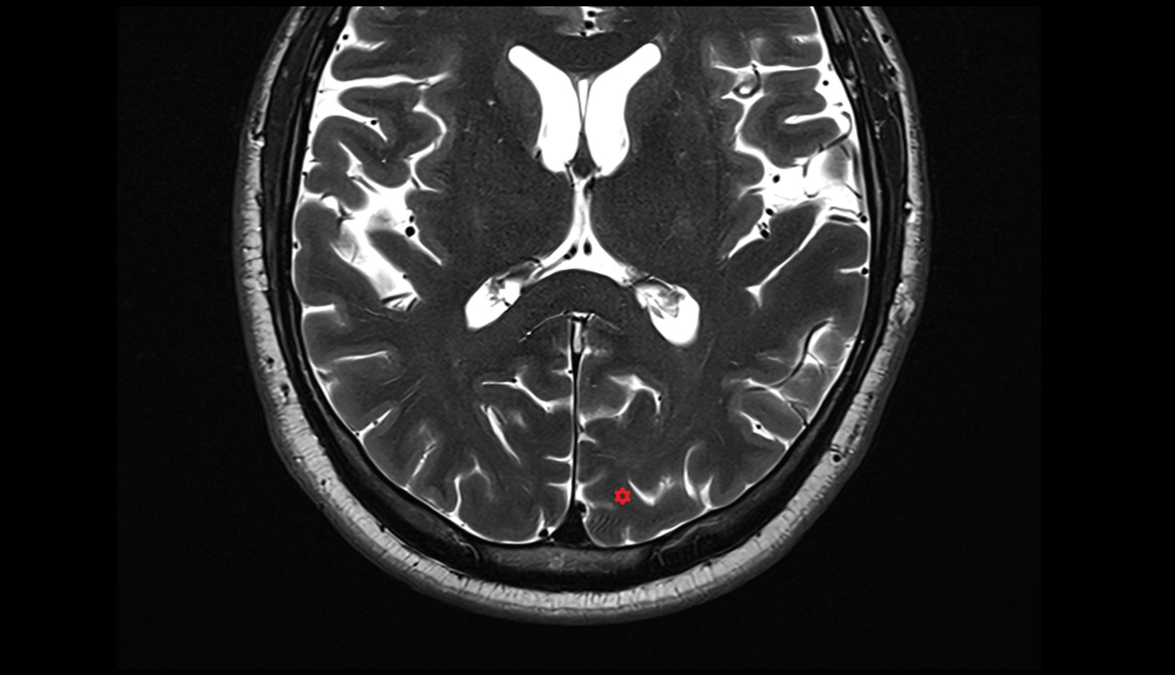Superior occipital gyrus mri 3t axial image
