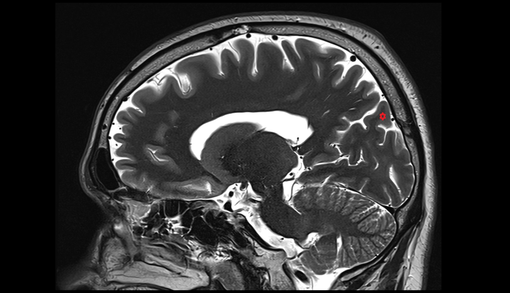 Superior occipital gyrus mri 3t sagittal image