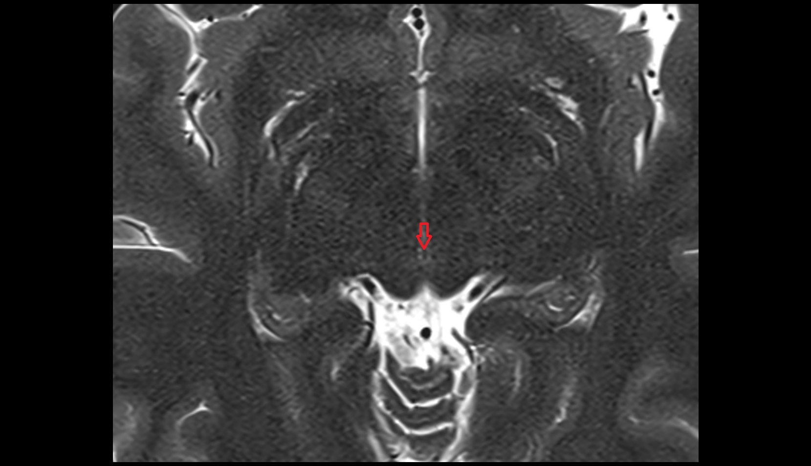 Superior opening of cerebral aqueduct AXIAL