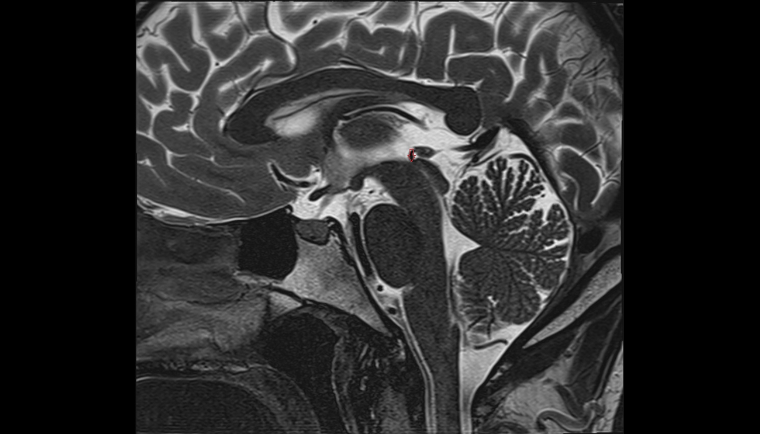 Superior opening of cerebral aqueduct  mri sag  image -img-00000-00000
