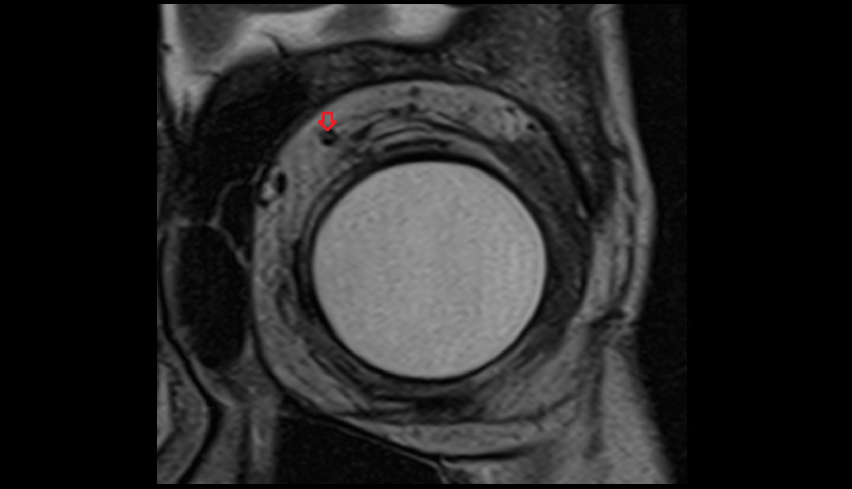 Superior ophthalmic vein mri image