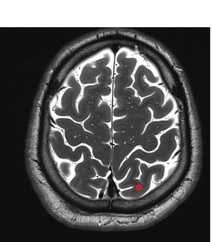 Superior parietal lobule mri 3t axial image