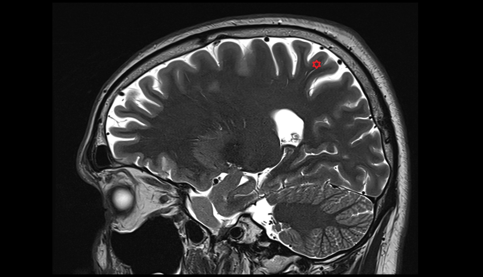 Superior parietal lobule mri 3t sagittal image