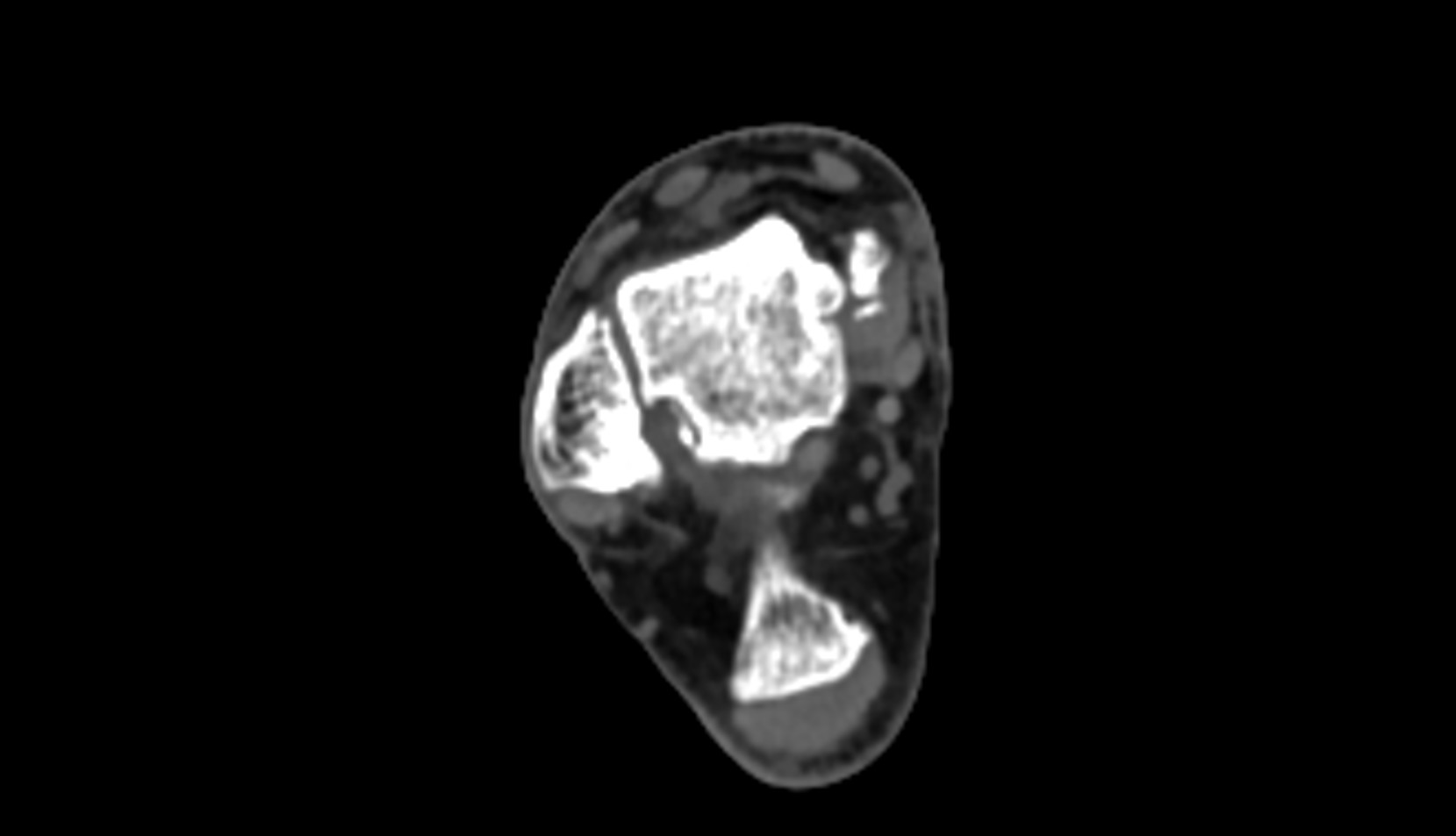 Superior peroneal (fibular) retinaculum ct axial image