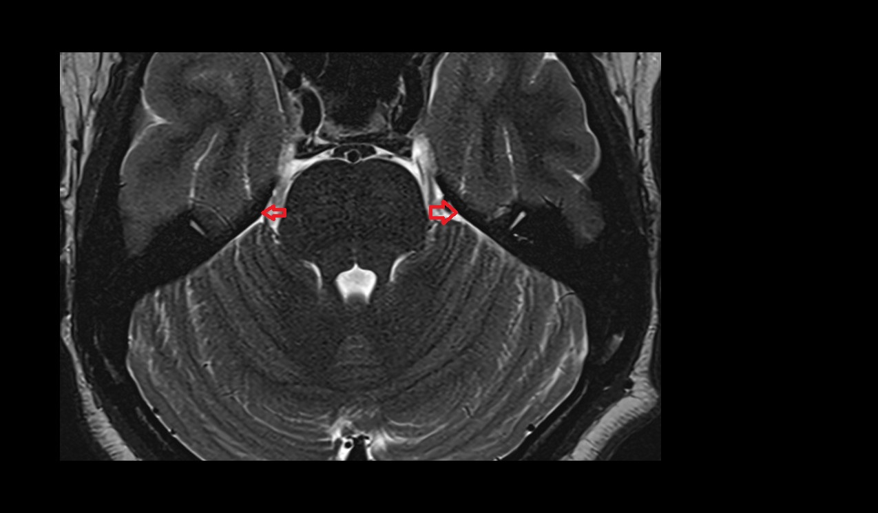 Superior petrosal sinus MI 3T axial image