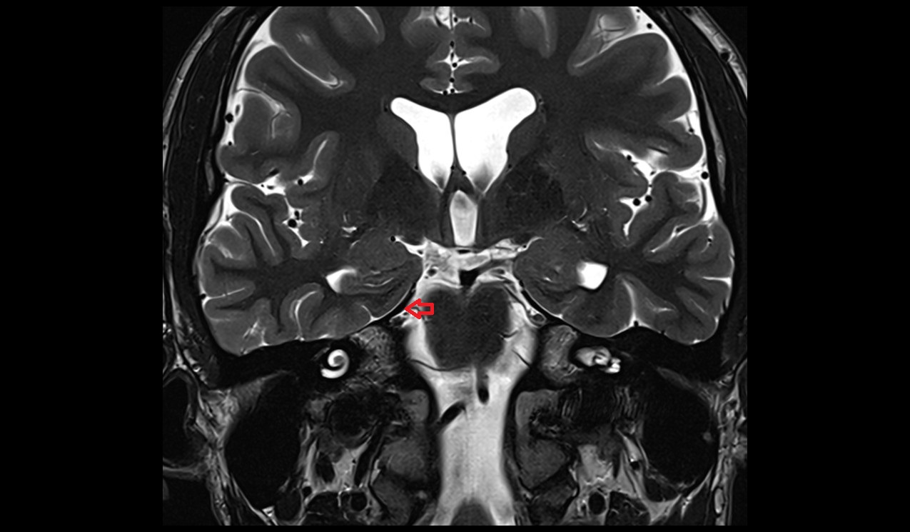Superior petrosal sinus MI 3T coronal image