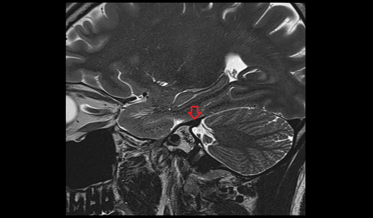 Superior petrosal sinus MI 3T sagittal  image