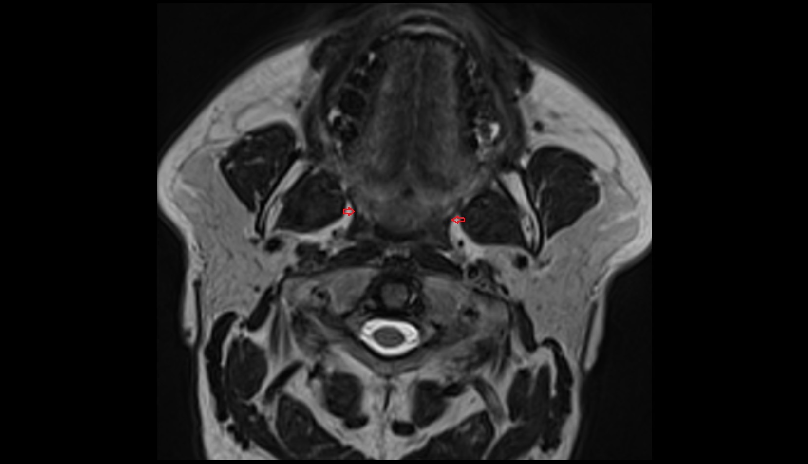 Superior pharyngeal constrictor muscle mri axial image