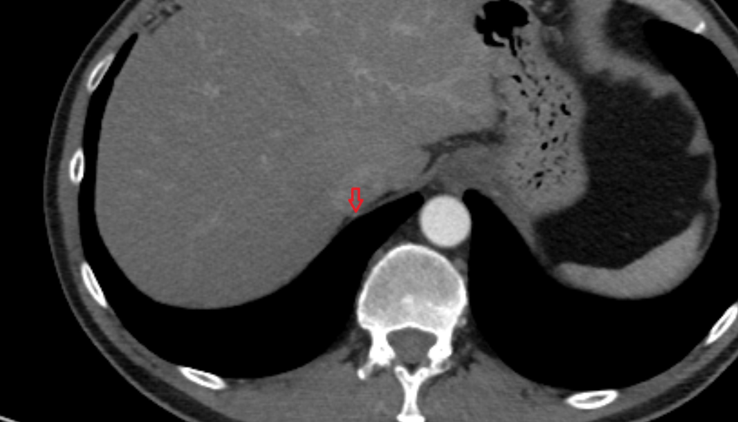 Superior phrenic artery anatomy CT axial  image -img-00000-00000_00001