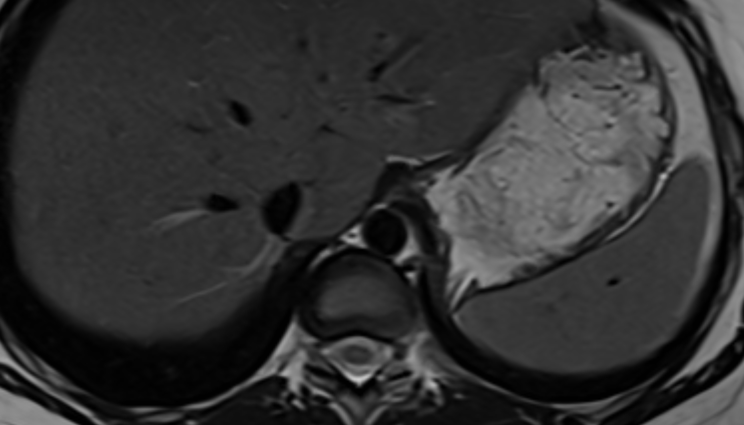Superior phrenic artery anatomy MRI axial  image -img-00000-00000