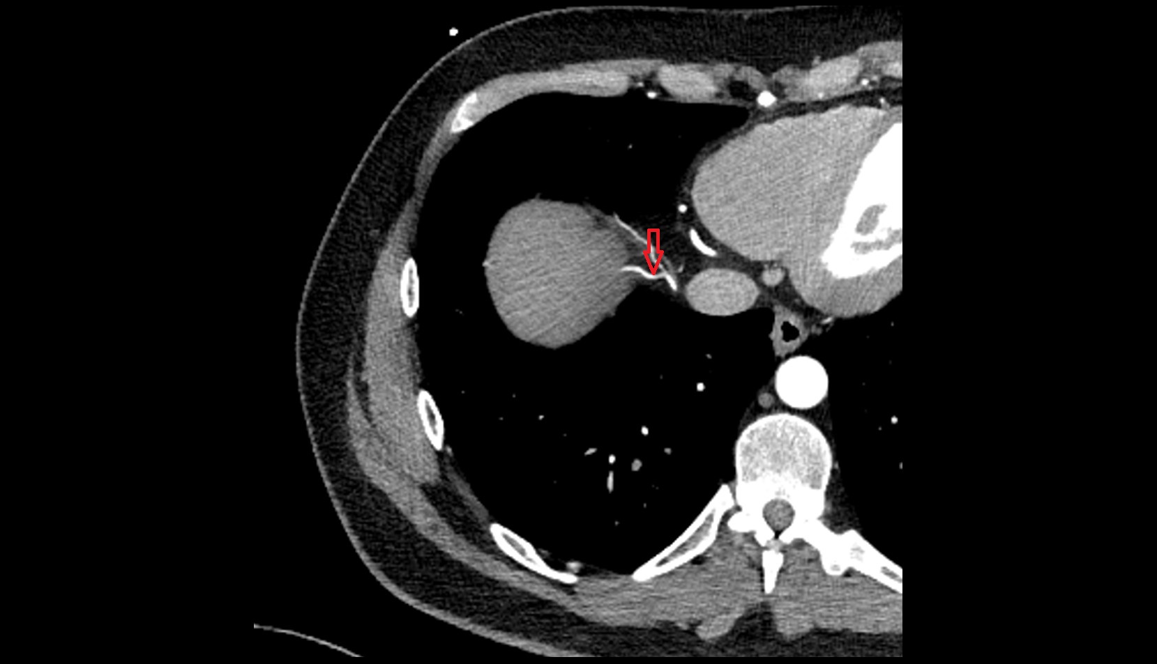 Superior phrenic artery anatomy CT axial  image -img-00000-00000