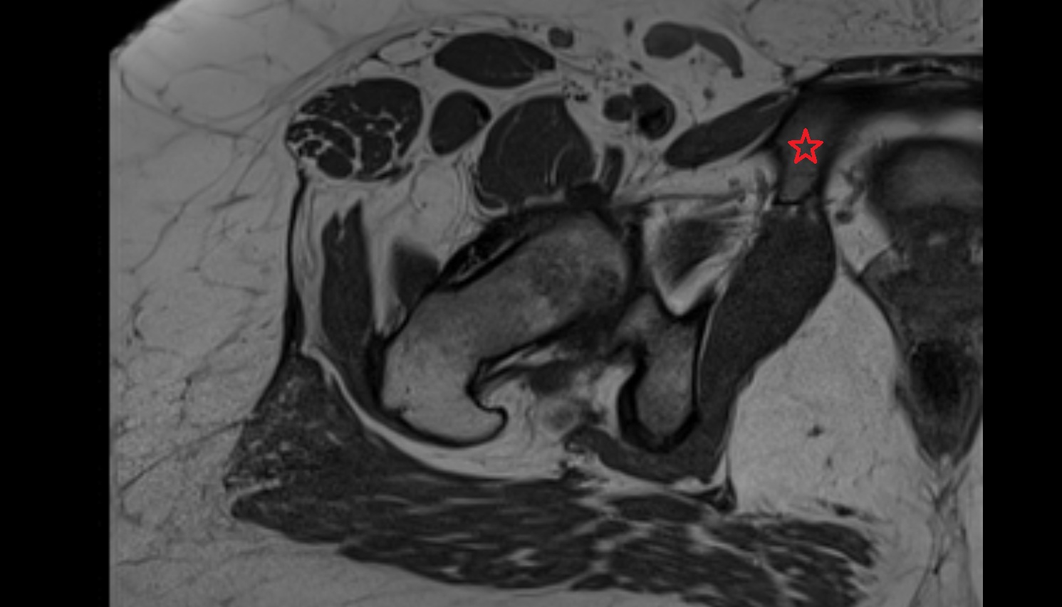 Superior pubic ramus  MRI  axial  anatomy  image-img-00000-00000