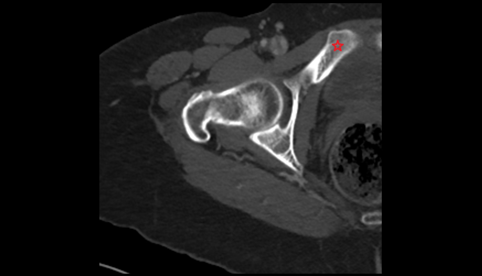 Superior pubic ramus ct axial image