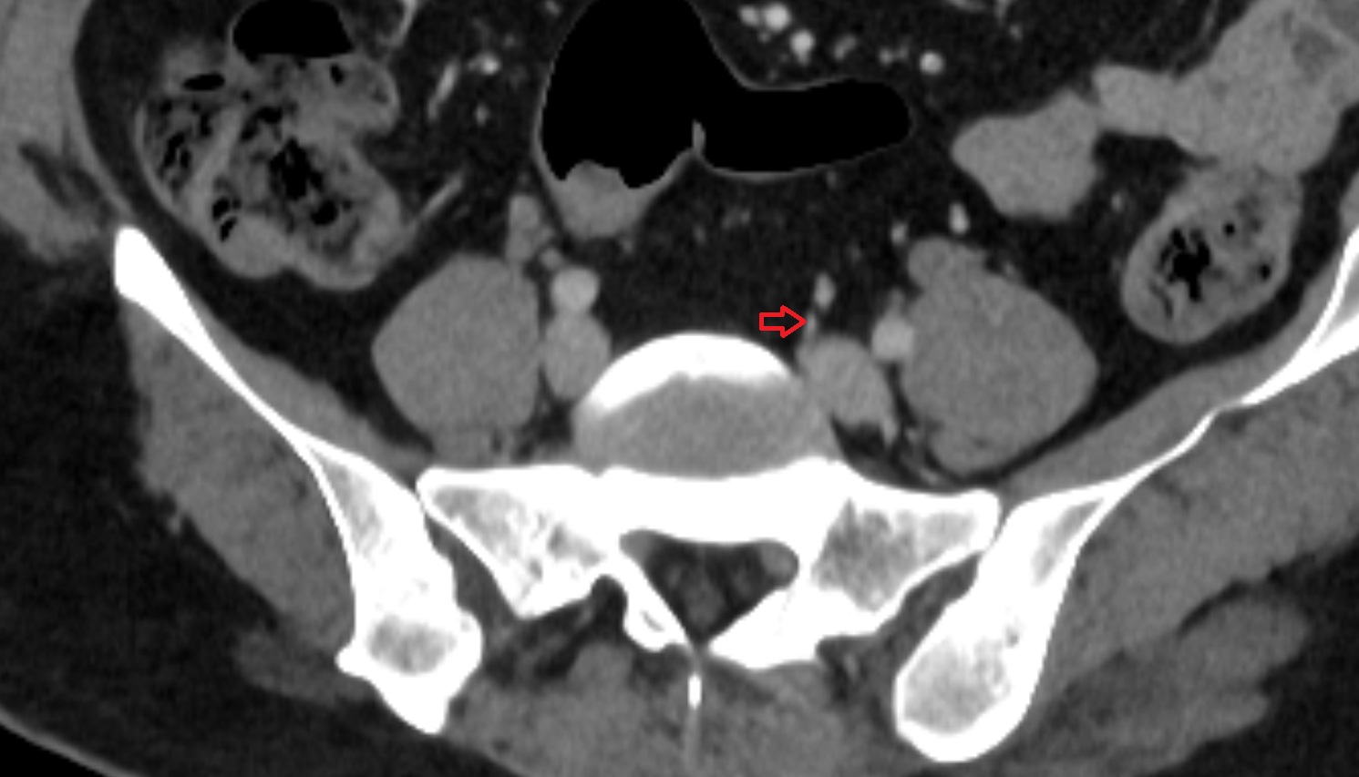 Superior rectal artery AXIAL CT  anatomy  image -img-00000-00000