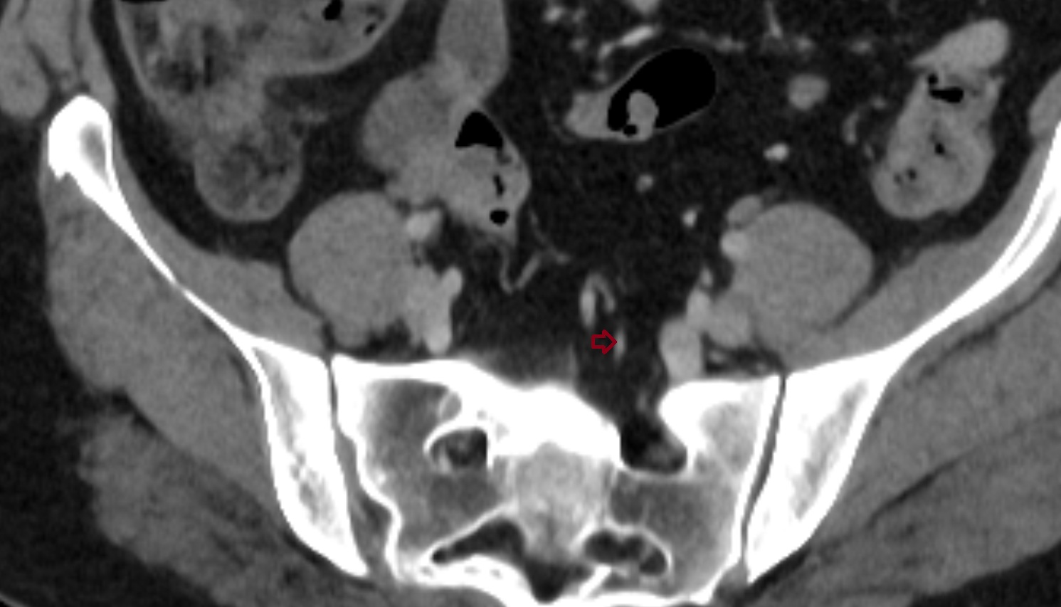Superior rectal artery AXIAL CT  anatomy  image -img-00000-00000_00001