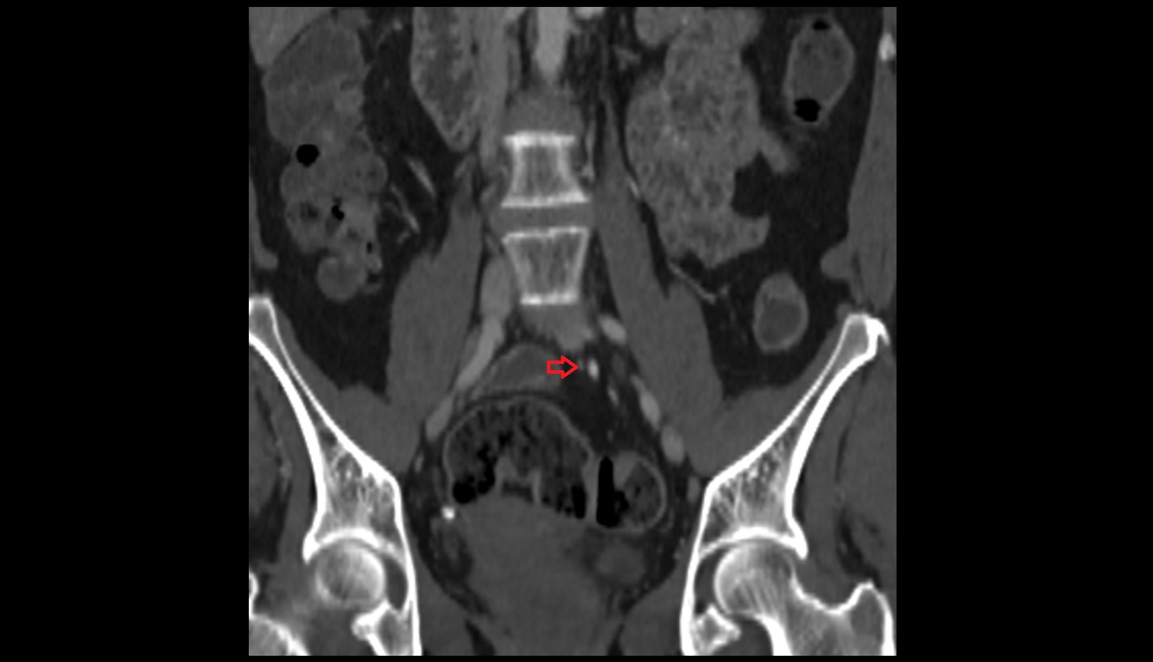 Superior rectal artery CORONAL CT  anatomy  image -img-00000-00000