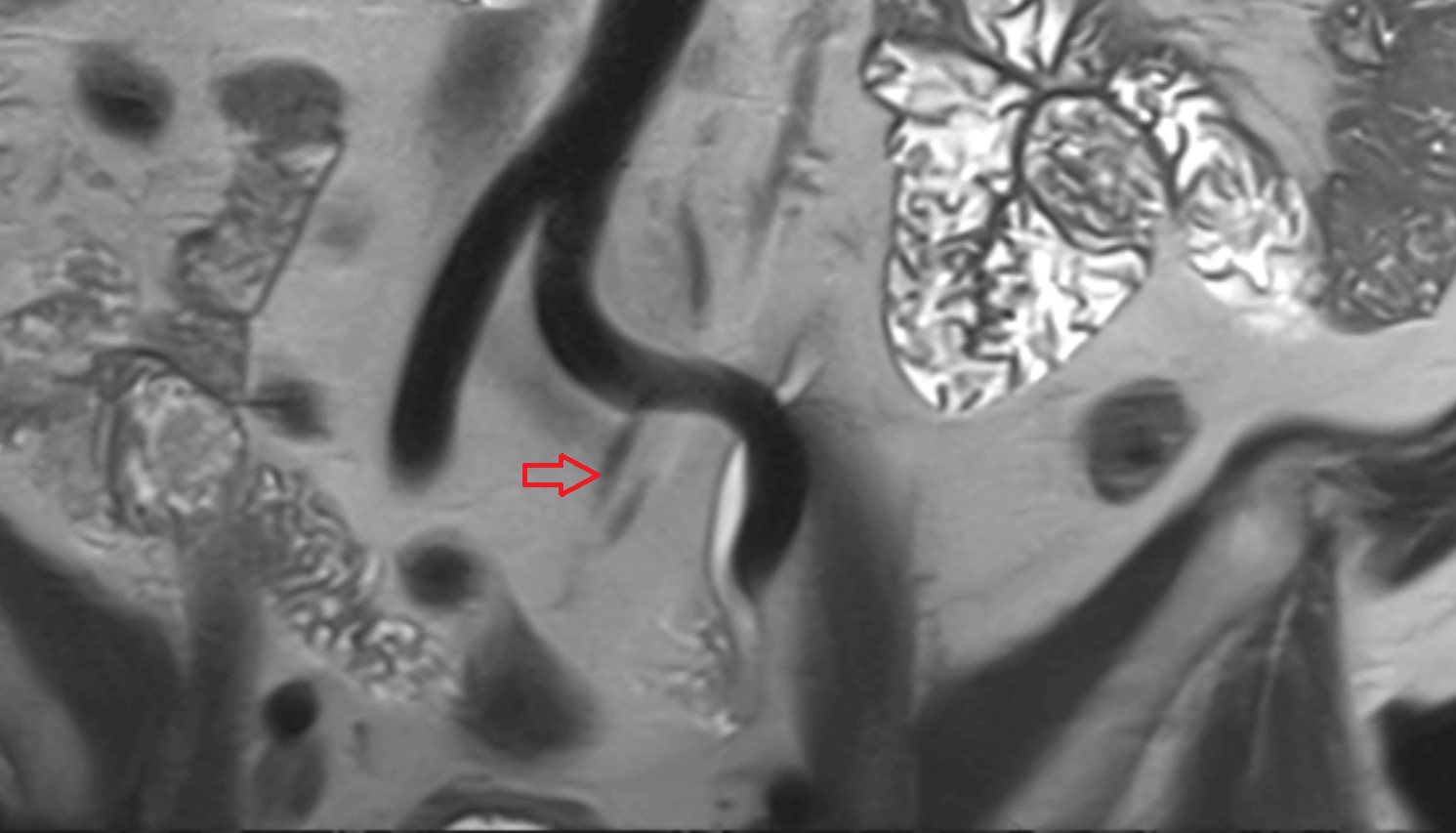 Superior rectal artery  coronal mri  anatomy  image -img-00000-00000