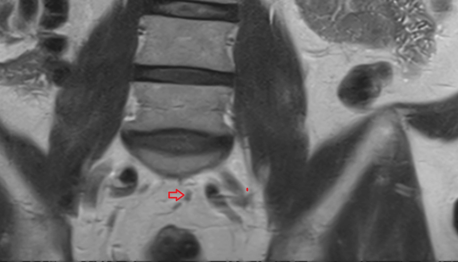 Superior rectal artery  coronal mri  anatomy  image -img-00000-00000_00001