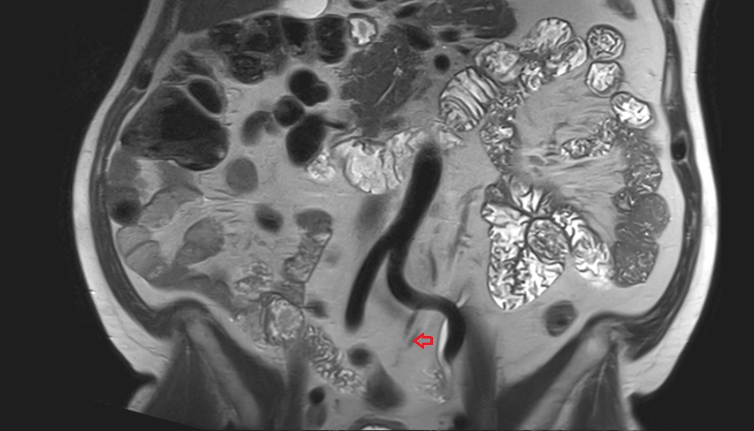 Superior rectal vein  MRI coronal  anatomy  image -img-00000-00000