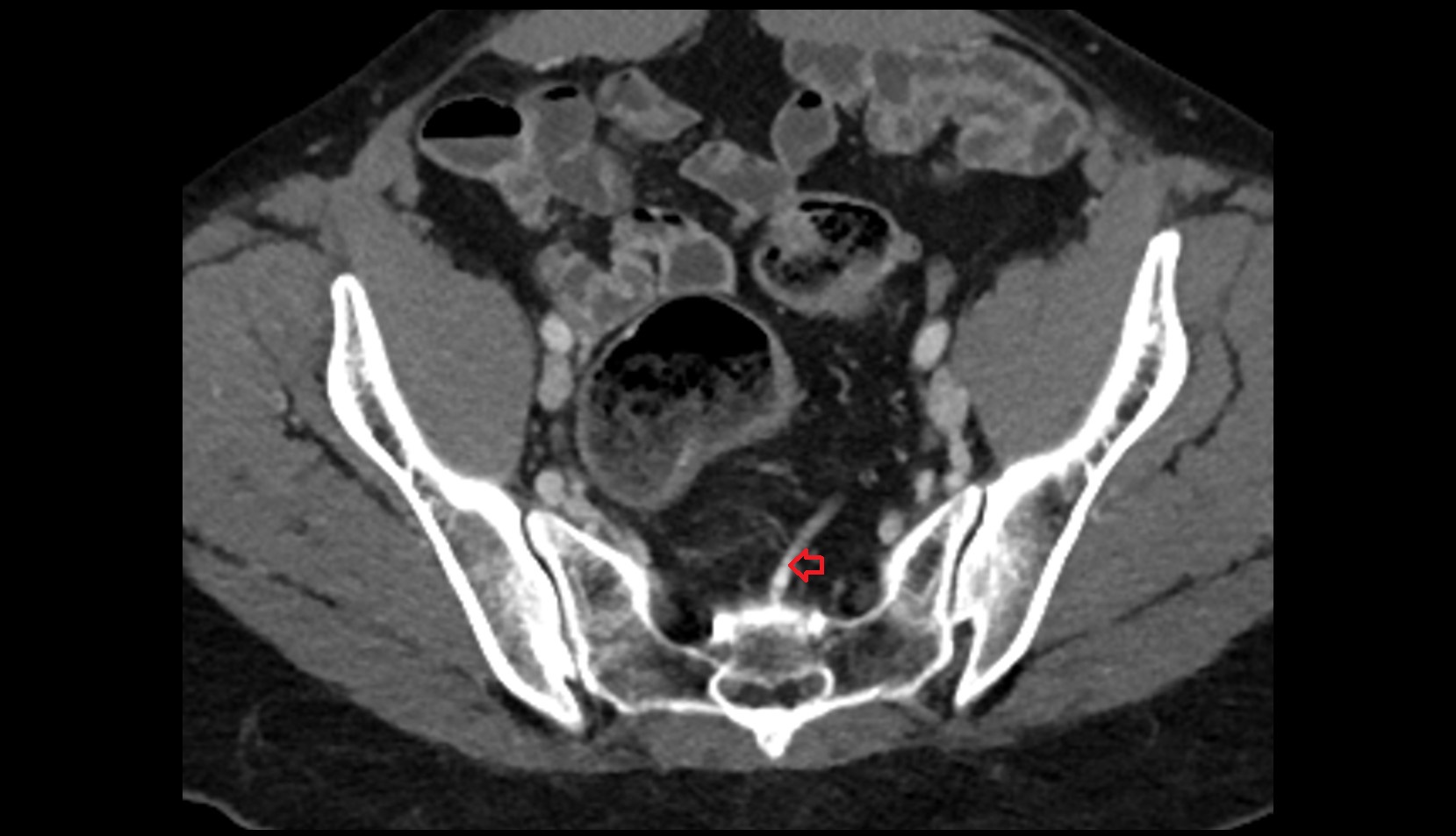 Superior rectal vein ct axial image 2