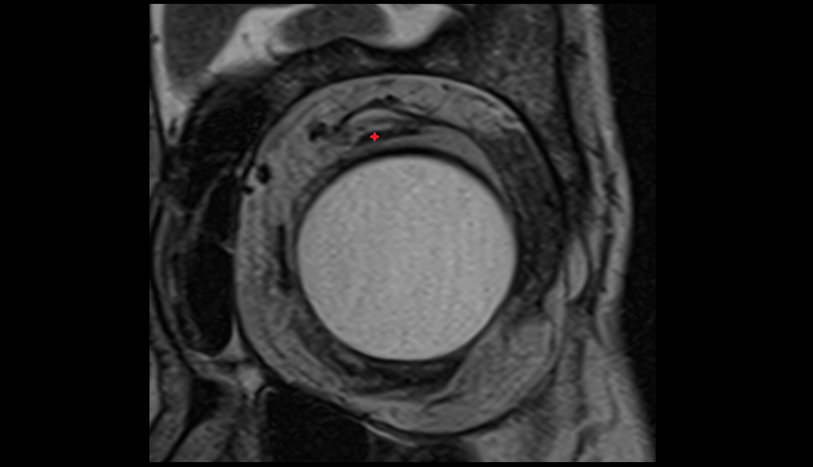 Superior rectus muscle mri image