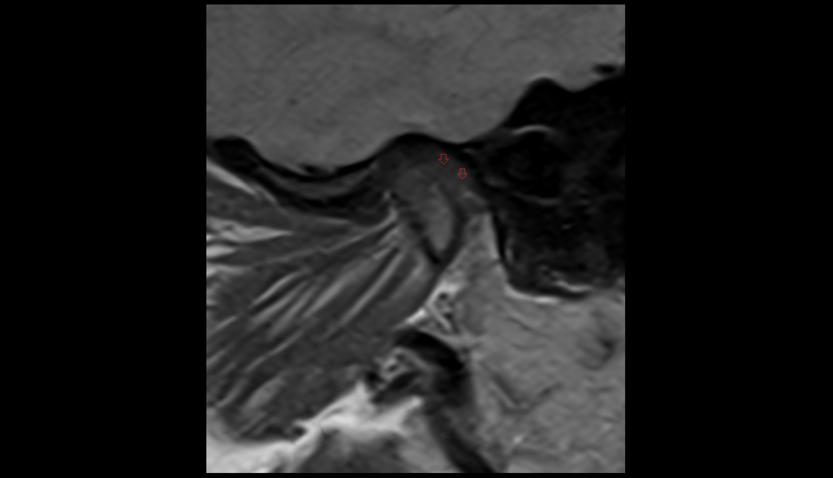 Superior retrodiscal layer