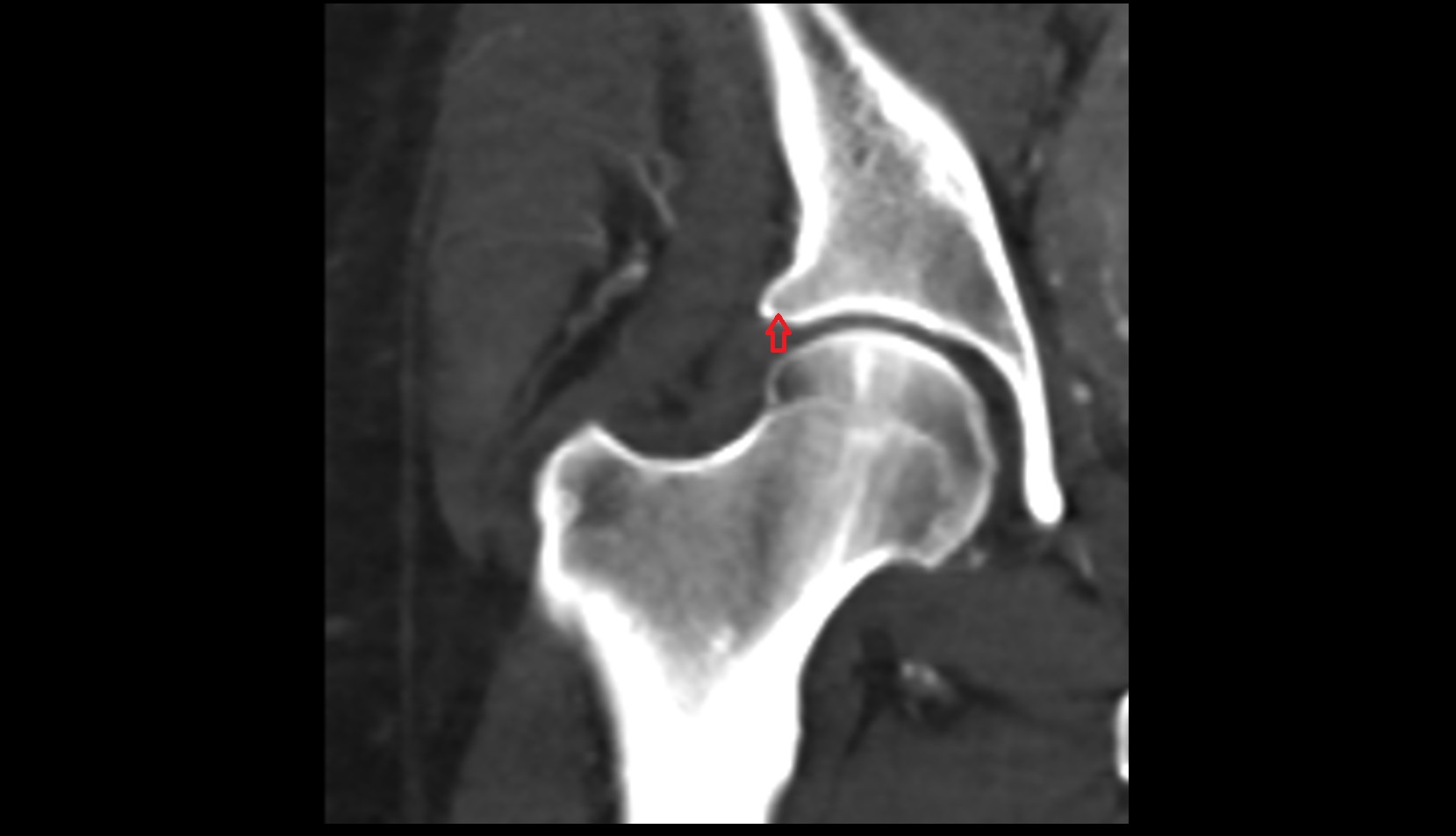 Superior rim of acetabulum ct coronal