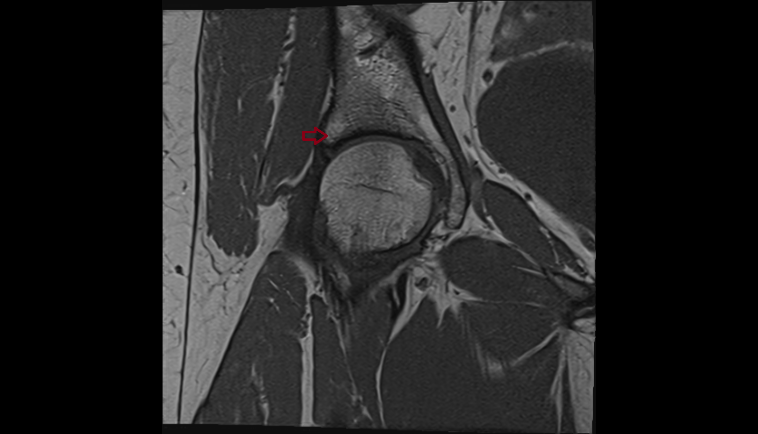 Superior rim of acetabulum  mri  anatomy labelled image-img-00000-00000