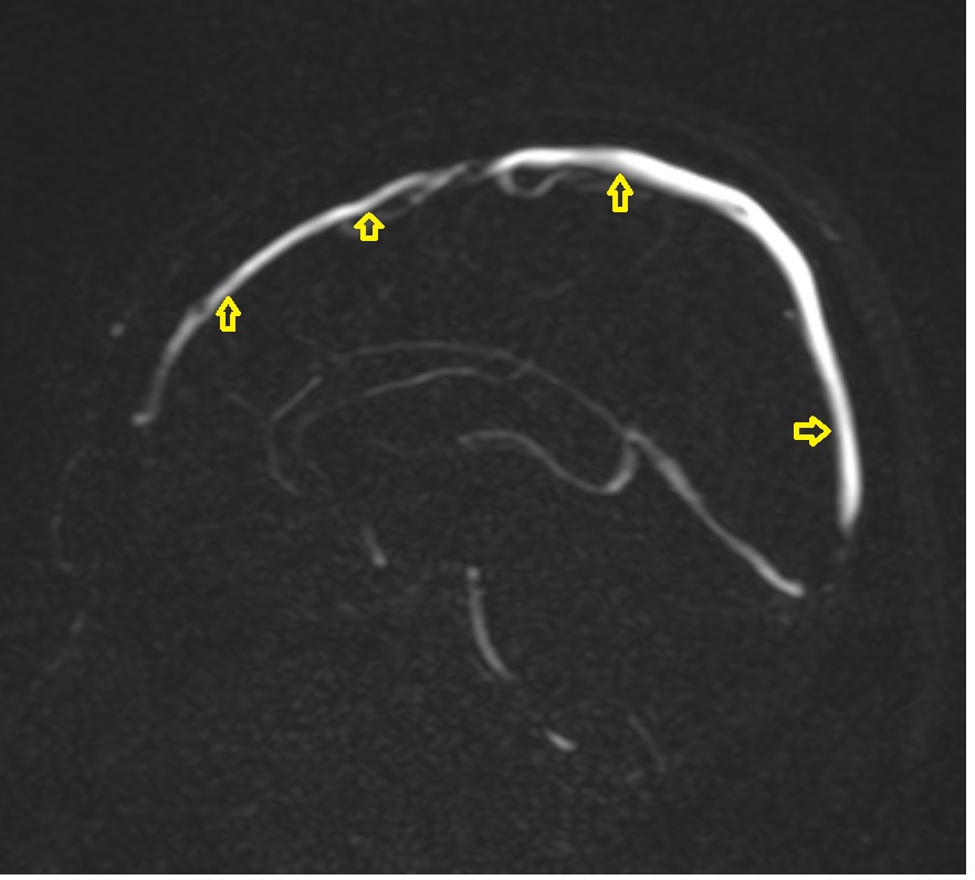 Superior sagittal sinus MRI 3T sagittal MIP PC 3D image