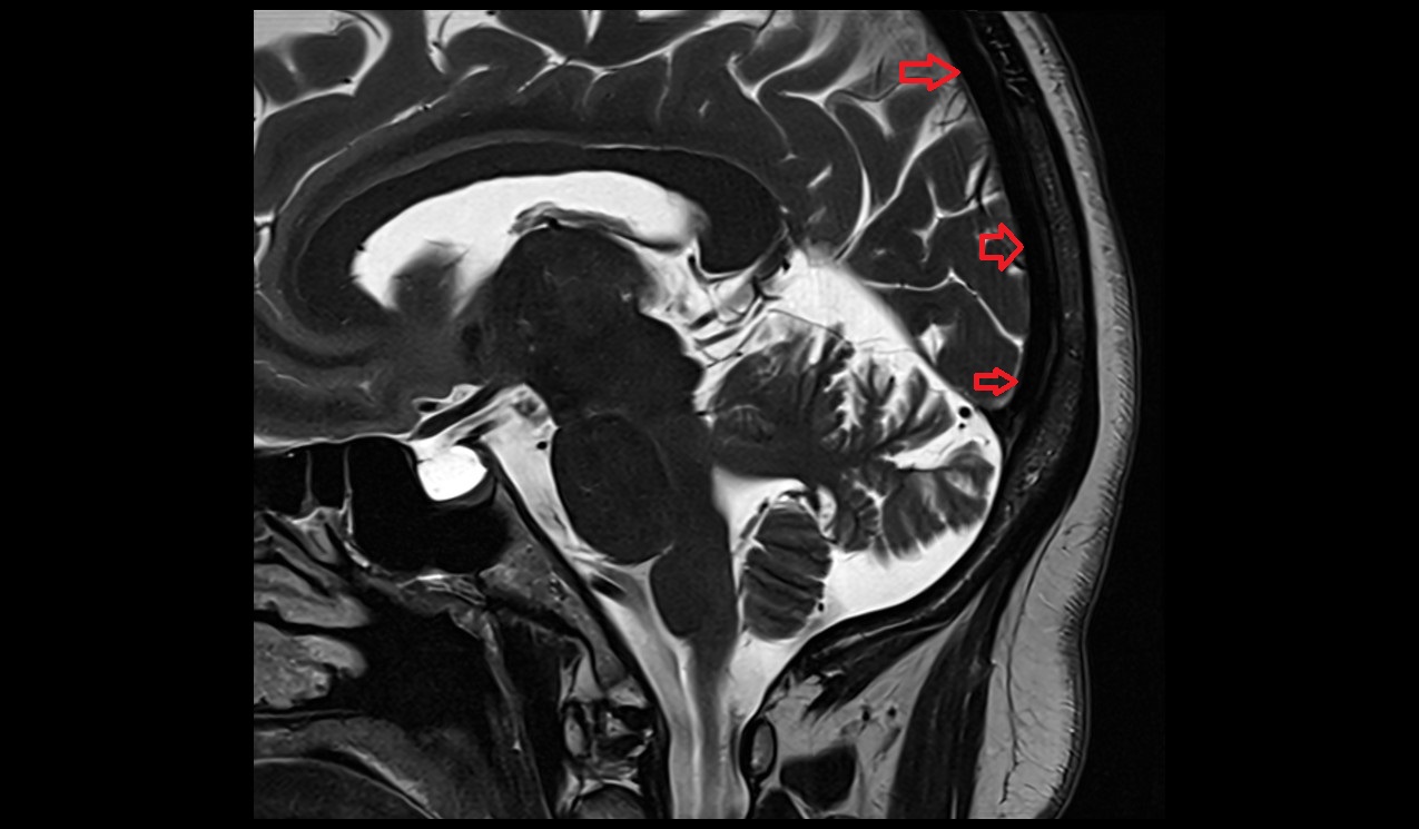 Superior sagittal sinus MRI 3T sagittal image