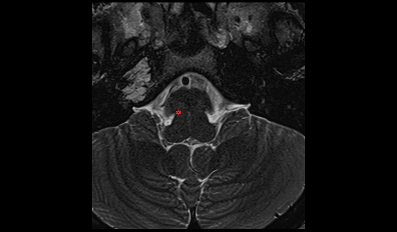 Superior salivatory nucleus MRI 3T image