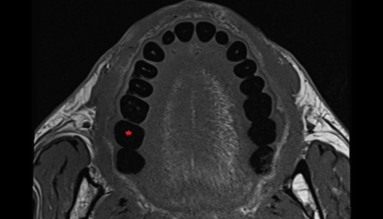Superior second molar tooth  mri axial  image -img-00000-00000
