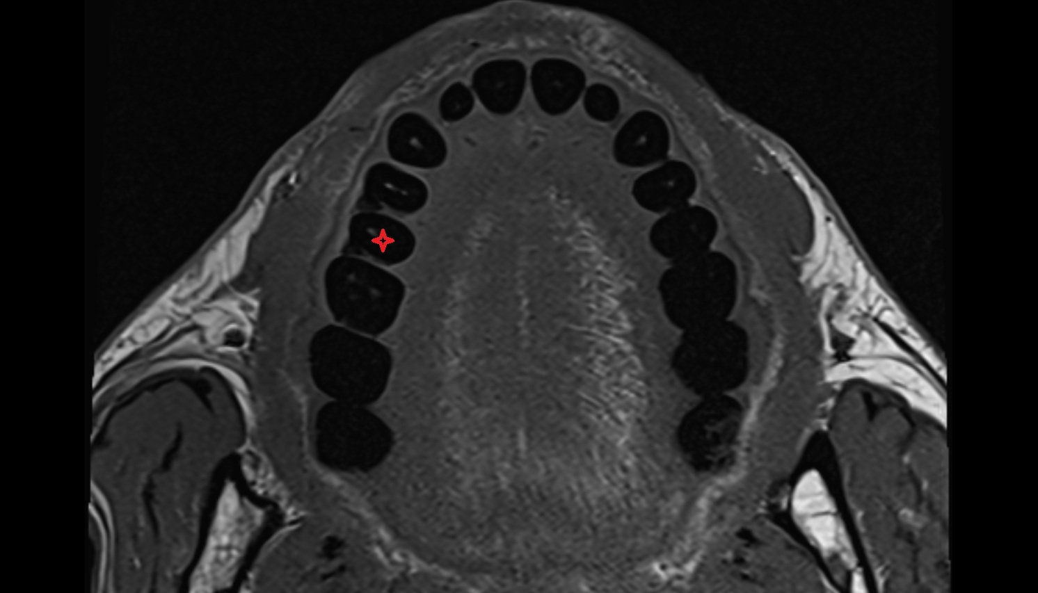 Superior second premolar tooth  mri axial  image -img-00000-00000