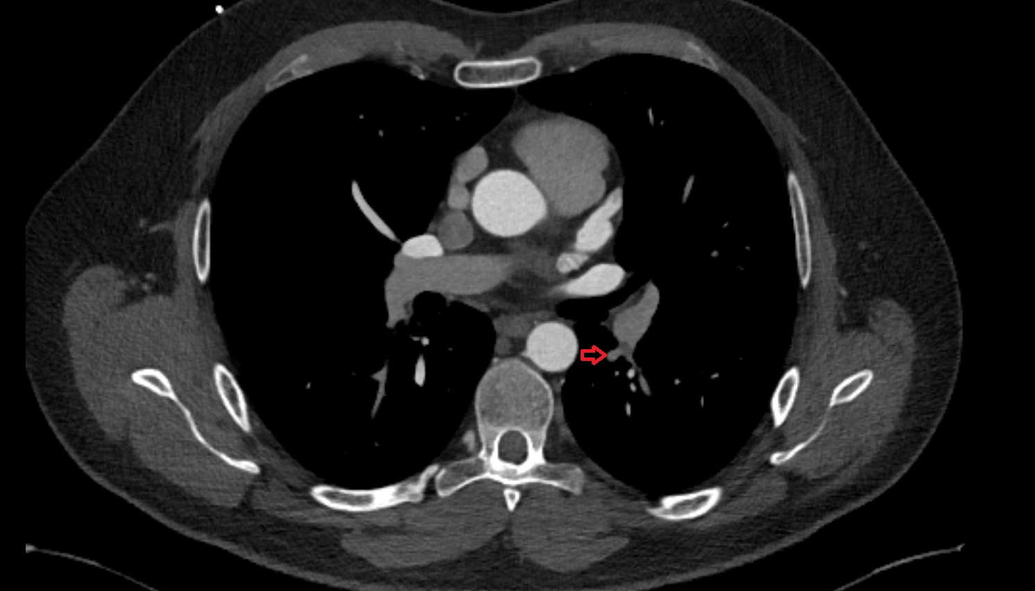 Superior segmental artery of left lung anatomy ct axial  image -img-00000-00000