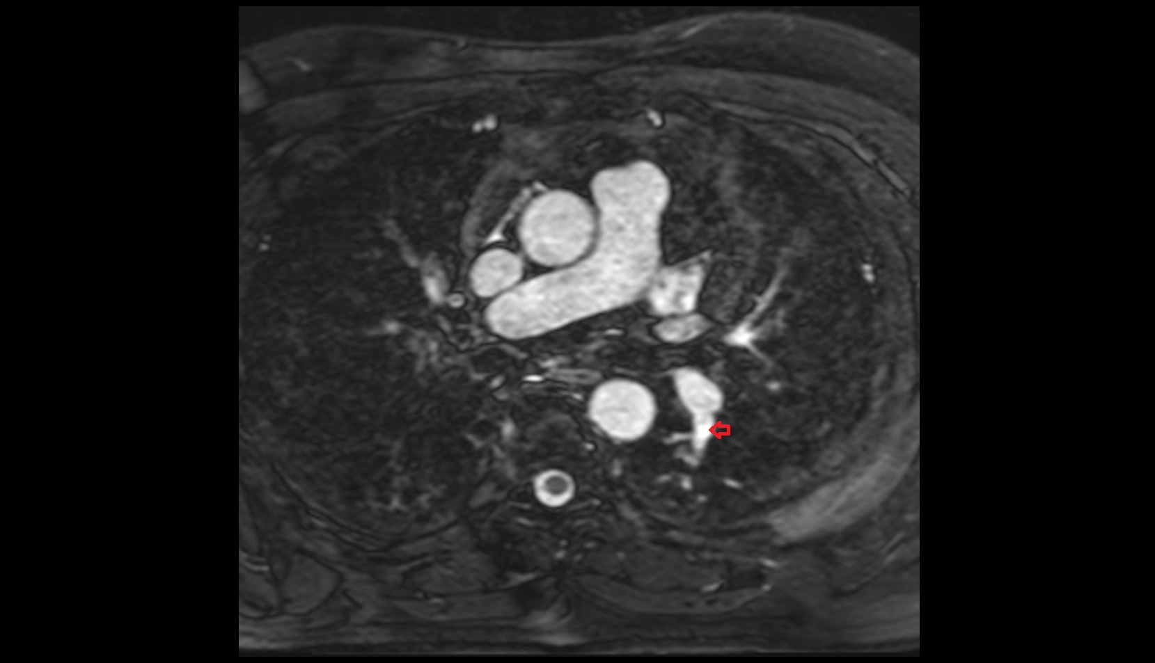 Superior segmental artery of left lung  mri axial image