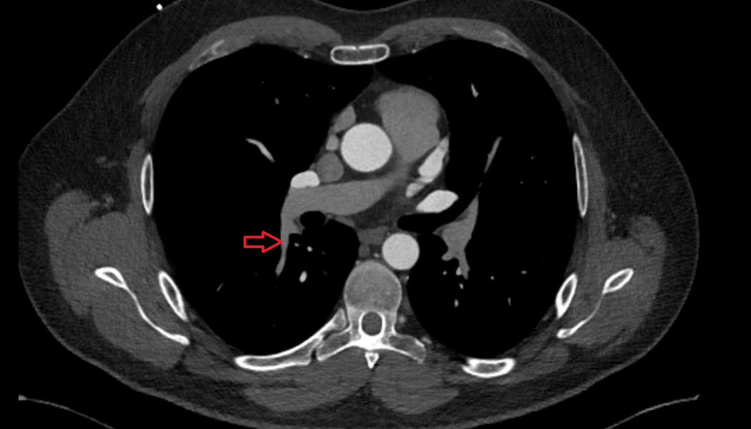 Superior segmental artery of right lung  anatomy ct axial  image -img-00000-00000