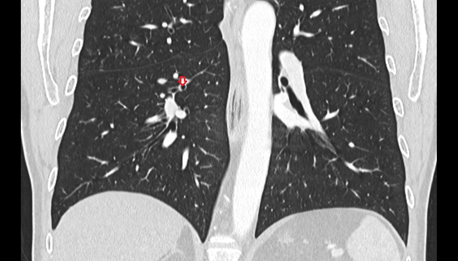 Superior segmental bronchus of right lung (B6)  anatomy  CT coronal  image -img-00000-00000