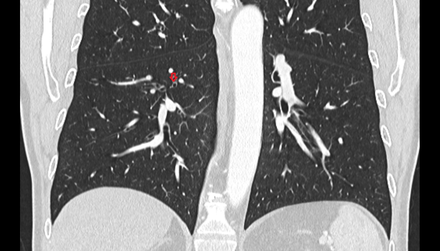 Superior segmental bronchus of right lung (B6)  anatomy  CT coronal  image -img-00000-00000_00001