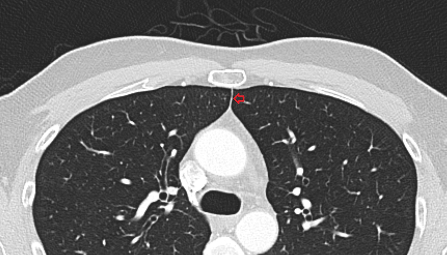 Superior sternopericardial ligaments  anatomy CT axial  image -img-00000-00000