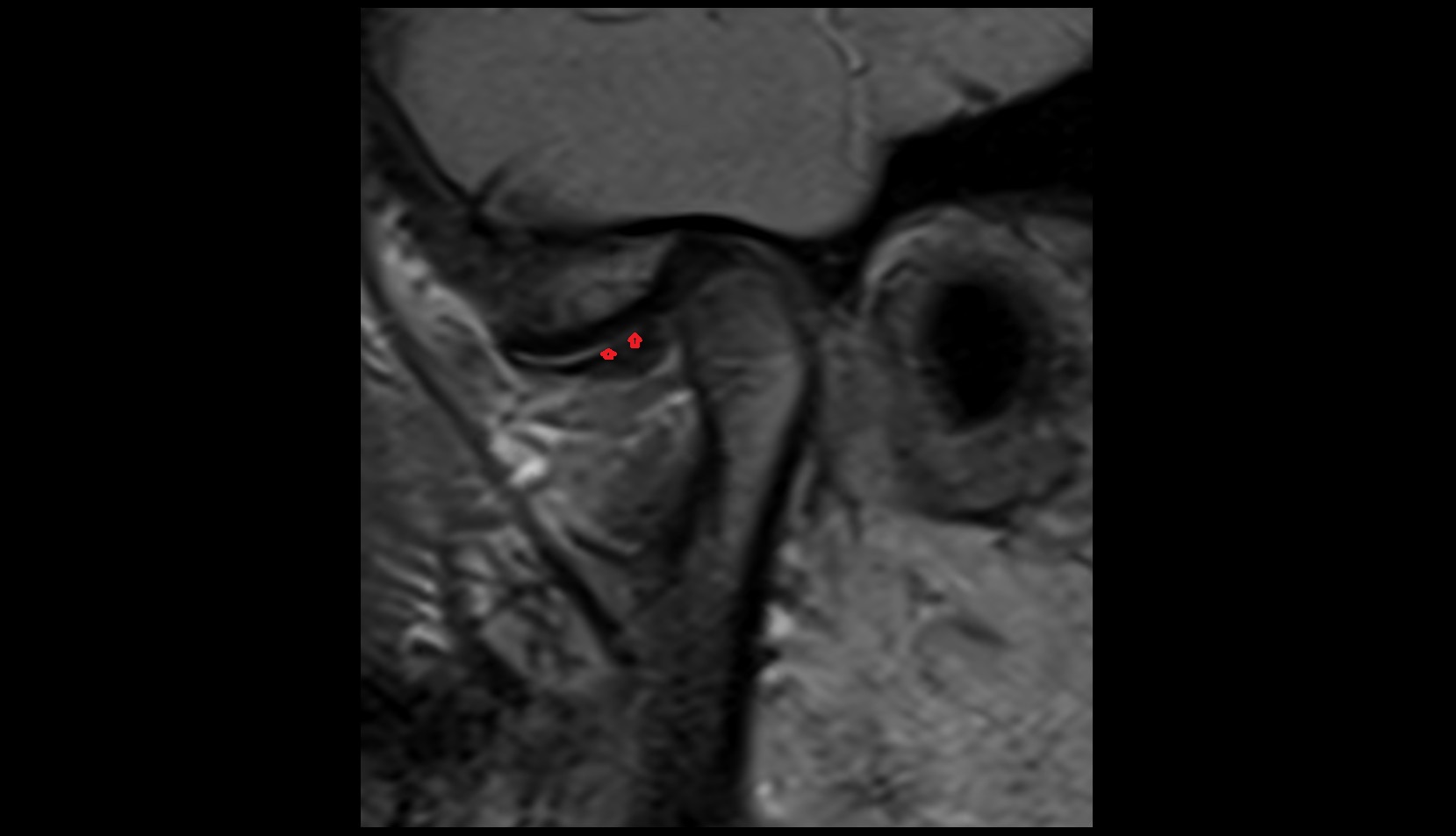 Superior synovial membrane of temporomandibular joint
